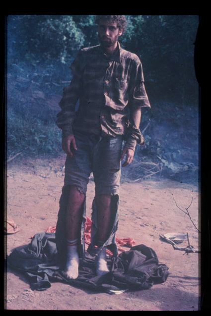 Yossi Ghinsberg after rescue in Bolivia, 1981